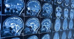 Annals of Neurology: раскрыты ранее неизвестные функции области в височной доле мозга