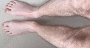The Lancet: эксперты рассказали о симптоме «синих ног» при длительном COVID
