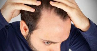 NC: учёными найдены редкие гены, из-за которых у мужчин выпадают волосы