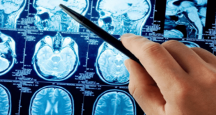 Ученые провели исследование и выяснили, как меняется мозг после инсульта