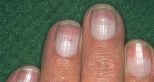 JAMA Dermatology: образования на ногтях повышают риск развития рака