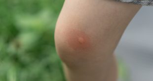 CorkBeo: 69-летняя женщина лишилась ног после укуса насекомого в Ирландии