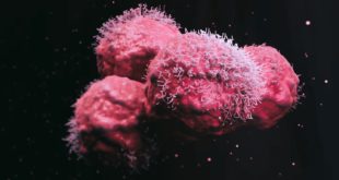 Британские ученые нашли способ определять риск рецидива рака молочной железы